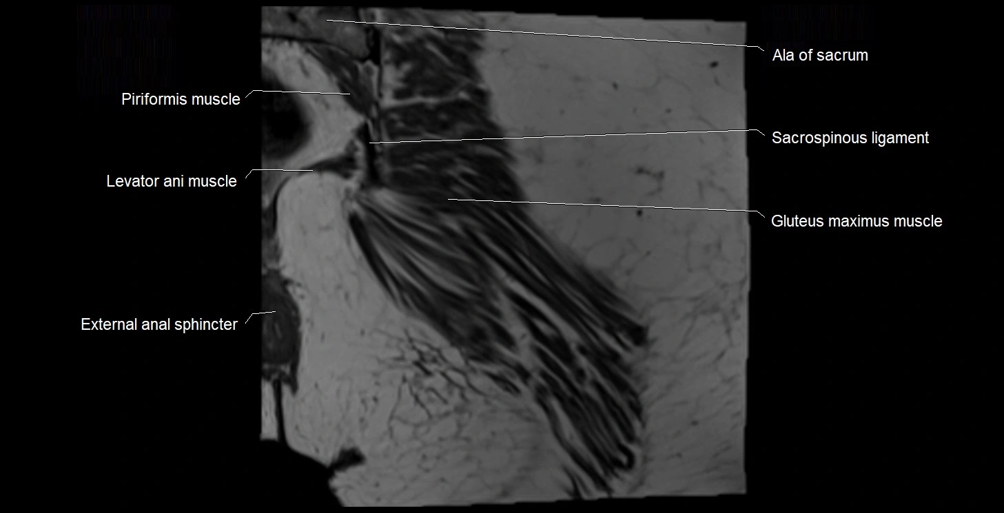 MRI Hip 3T coronal cross sectional anatomy image 60.webp